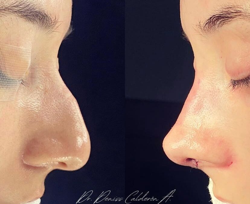 Ultrasonic Rhinoplasty in Cuenca: Regain Confidence with Natural Results