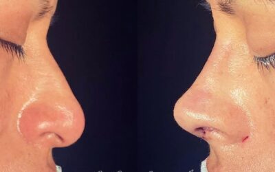 Rinoplastia Ultrasónica en Cuenca: Recupera la Confianza con Resultados Naturales