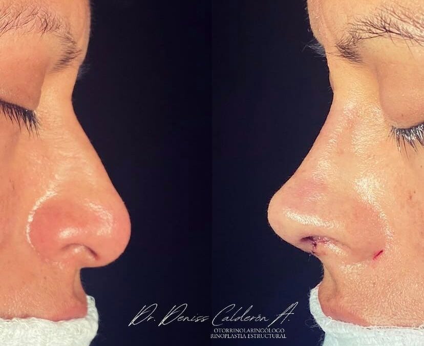 Rinoplastia Ultrasónica en Cuenca: Recupera la Confianza con Resultados Naturales