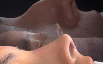 ¿Qué esperar después de una rinoplastia ultrasónica? Recuperación paso a paso