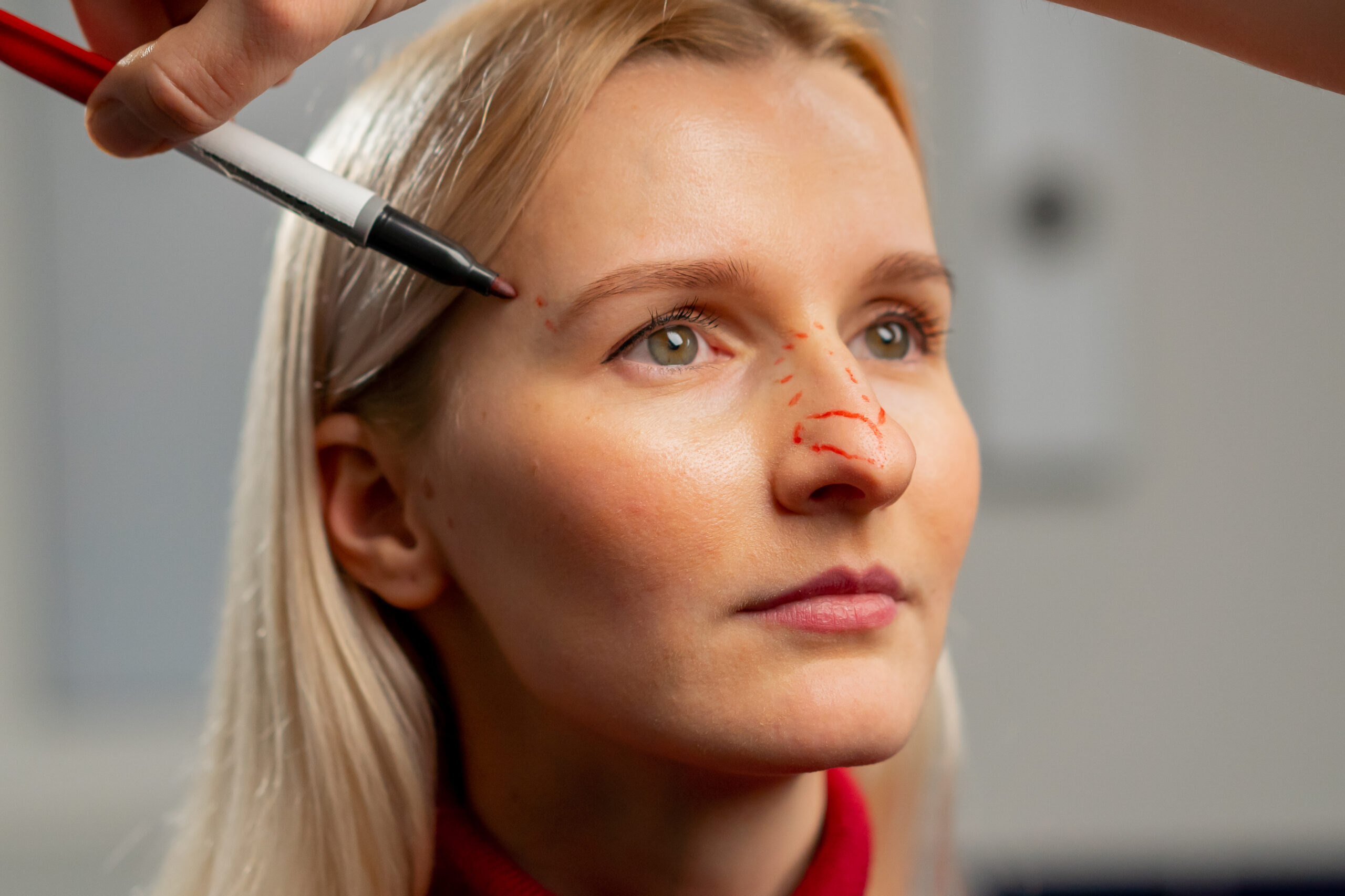 Armonía facial con precisión: El valor de una rinoplastia ultrasónica personalizada