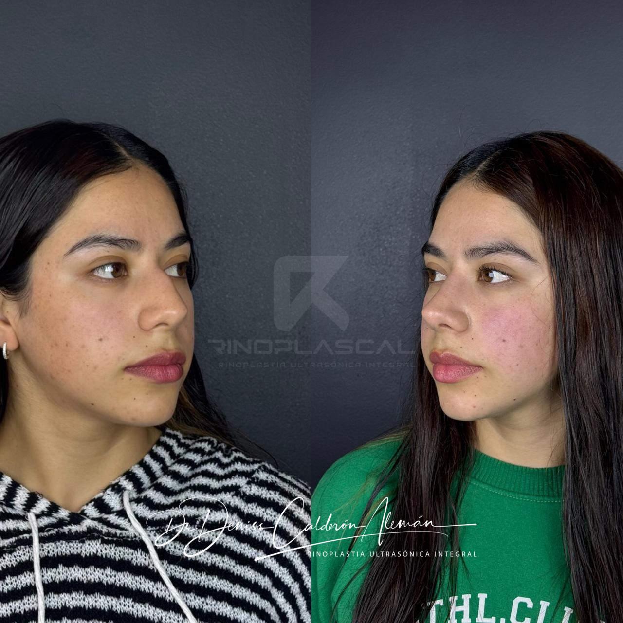 resultados-rinoplastia-cuenca-dr-deniss-calderon